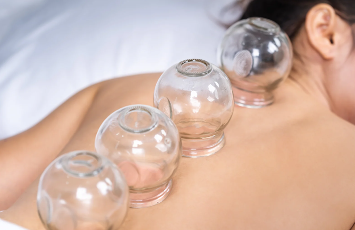 Cupping Massage FairfaxStation Chiropractic